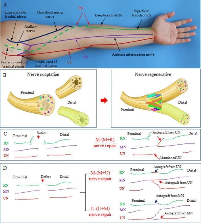 Educational medical illustration detailing upper limb nerve anatomy and surgical nerve merging repair techniques. Panel A is an anatomical diagram overlaid on a human arm showing the brachial plexus cords (lateral, posterior, medial) and the primary nerves: Musculocutaneous, Axillary, Radial (RN), Median (MN), and Ulnar (UN), including the deep and superficial RN branches and the anterior interosseous nerve. Panel B illustrates the concept of 'magnified nerve regeneration,' showing nerve coaptation where one proximal nerve trunk is sutured to two distal nerve segments to facilitate dual innervation. Panels C and D provide schematics of specific surgical protocols: M-(M+R) repair, where the proximal MN is connected to distal MN and RN segments while abandoning the UN; and M-(M+U) or U-(U+M) repairs, which utilize Y-shaped coaptations and autografts (often derived from sacrificed or donor segments) to bridge defects. The illustration serves as a clinical guide for repairing complex nerve avulsions or defects in the upper extremity by using fewer proximal donors to reinnervate multiple distal targets.
