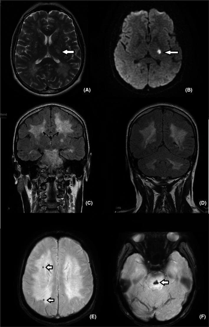 Six-panel brain MRI study demonstrating acute and chronic neurovascular findings. (A) Axial T2-weighted and (B) Diffusion-Weighted Imaging (DWI) show a focal hyperintense lesion (arrows) in the posterior limb of the left internal capsule, diagnostic of an acute lacunar ischemic stroke. (C, D) Coronal Fluid-Attenuated Inversion Recovery (FLAIR) images reveal extensive, confluent white matter hyperintensities (WMH) involving both supratentorial and infratentorial regions, representing severe small vessel disease or leukoaraiosis. (E, F) Susceptibility-Weighted Imaging (SWI) sequences identify multifocal hypointense 'blooming' artifacts (arrows) located in the centrum semiovale and the midline of the pons. These signal voids are consistent with chronic hemosiderin deposits or microbleeds. The combination of findings—acute lacunar infarct, diffuse leukoencephalopathy, and microhemorrhages—is highly characteristic of cerebral small vessel disease and hypertensive vasculopathy.