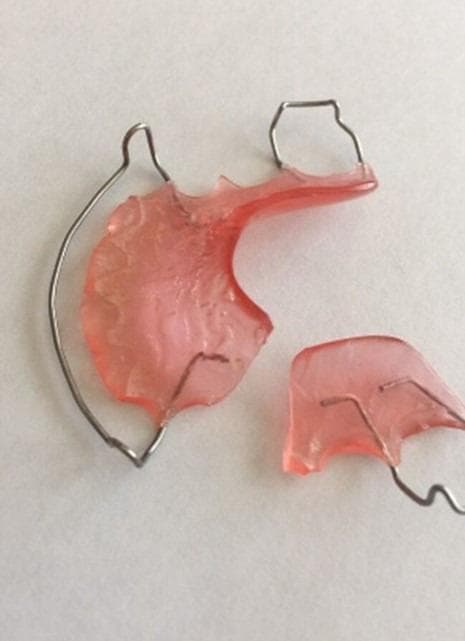 Clinical photograph of a fractured removable orthodontic appliance, likely a Hawley retainer or similar palatal expansion plate. The image shows the appliance separated into two distinct fragments against a neutral background. The primary components consist of a pink, translucent acrylic base and a stainless steel wire framework. The larger fragment maintains a portion of the palatal plate and includes an Adams clasp and a labial bow wire. The smaller fragment is a sheared section of the acrylic base with embedded wire terminals. The fracture line is irregular and jagged, traversing the mid-section of the acrylic body. This structural failure renders the appliance non-functional, as it cannot properly distribute orthodontic forces or maintain fit. The photograph serves as an educational example of common dental appliance damage, highlighting the need for clinical replacement or professional laboratory repair to restore structural integrity and ensure patient safety.
