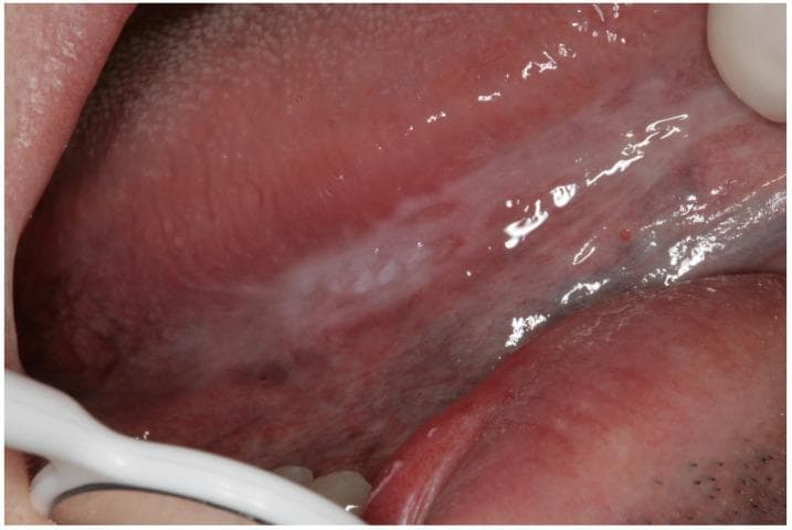 This clinical photograph shows a close-up intraoral view of the lateral border of the tongue. A distinct, predominantly white, plaque-like lesion (leukoplakia) is visible, characterized by an irregular shape and non-homogeneous texture. The lesion appears as a thickened, slightly raised white patch with varying degrees of opacity. The surrounding oral mucosa displays a typical pinkish-red hue with visible minor vascularity and small dark punctate spots nearby. Such lesions are classified as oral potentially malignant disorders (OPMDs) and require clinical evaluation and biopsy to rule out incipient oral squamous cell carcinoma. The image serves as an educational example of how early-stage oral cancer or high-risk dysplasia can manifest as a persistent white plaque on the tongue's lateral surface.