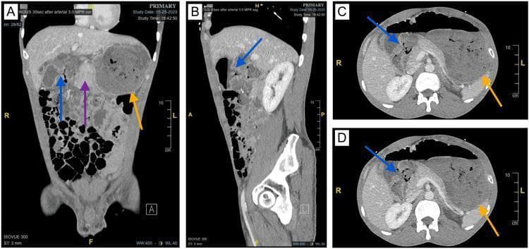 Diagnostic CT imaging of the abdomen and pelvis presented in coronal (A), sagittal (B), and axial (C, D) planes, demonstrating complications of peptic ulcer disease. The visual findings include severe edema of the gastric pylorus and duodenum (purple arrow), which has led to significant gastric outlet obstruction. This obstruction is evidenced by a markedly distended stomach containing retained gastric contents (orange arrows). Additionally, there is a localized area of increased soft tissue attenuation with focal gas and central necrosis, indicated by blue arrows, which suggests a contained or walled-off perforation of the duodenal wall. These images highlight the radiological features of complicated duodenal ulcers, including secondary obstructive changes and focal inflammatory masses associated with chronic perforation. This content is suitable for intermediate to advanced medical learners studying gastrointestinal pathology and radiology.