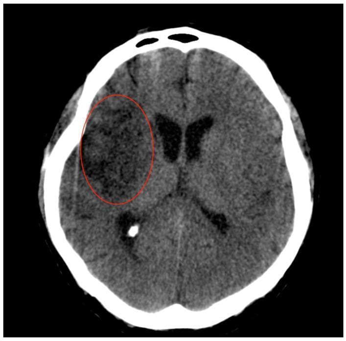 This diagnostic image is an axial non-contrast Computed Tomography (CT) scan of the brain, demonstrating a subacute ischemic infarct. A red oval highlights a large, well-demarcated area of hypodensity within the right hemisphere, specifically involving the fronto-temporal-insular regions. The hypodensity extends to include deep gray matter structures, notably the lentiform nucleus and the right caudate nucleus, consistent with a vascular territory supplied by the middle cerebral artery (MCA). The darker shade of gray within the highlighted region compared to the contralateral parenchyma indicates cytotoxic edema and tissue necrosis following ischemia. Key educational features include the loss of gray-white matter differentiation and the involvement of the lateral lenticulostriate arterial territory. This image illustrates the progression of cerebral infarction 7 days post-mechanical thrombectomy, serving as a clinical example of established ischemic stroke evolution and large vessel territory involvement in neurology and radiology education.