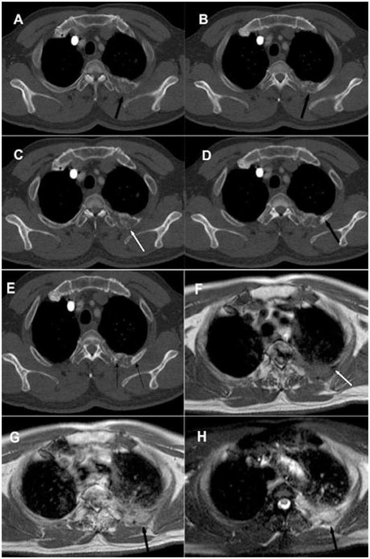 This composite diagnostic image features axial CT and MRI scans of a human thorax, demonstrating rib metastasis secondary to lung cancer. Panels A and B are 5mm slice thickness CT scans showing an expansive lesion in a posterior rib with predominant osteolytic characteristics. Panels C, D, and E utilize a 1mm thin-slice CT technique, revealing a mixed-pattern metastasis with distinct areas of osteolytic bone destruction (white arrow) and osteoblastic bone formation (black arrow). The MRI series (Panels F-H) provides further tissue characterization: T1-weighted imaging (F) shows the lesion with isometric to low signal intensity; Gadolinium-enhanced T1-weighted imaging (G) exhibits heterogeneous contrast enhancement; and T2-weighted fat-saturated imaging (H) displays a mixed high and low signal intensity. The comparison highlights the superior resolution of thin-slice CT (1mm) over standard CT (5mm) for identifying mixed metastatic features and the role of MRI in characterizing the soft tissue components and vascularity of secondary bone tumors.