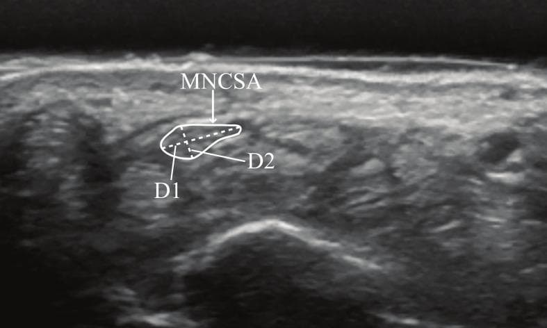 This diagnostic ultrasound image demonstrates a transverse view of the wrist at the proximal carpal tunnel level, specifically targeting the morphometry of the median nerve. The median nerve is highlighted within a solid white outline labeled 'MNCSA' (Median Nerve Cross-Sectional Area). It appears as a relatively hypoechoic, oval structure containing internal speckling representative of hypoechoic nerve fascicles separated by hyperechoic connective tissue. Two linear measurements are annotated within the nerve: 'D1' indicates the longitudinal diameter (the longer axis), and 'D2' indicates the vertical diameter (the shorter perpendicular axis). These quantitative parameters are clinically used to assess nerve compression, swelling, or deformation, which are hallmark diagnostic features of carpal tunnel syndrome. The nerve is situated superficial to the carpal bones and flexor tendons, bounded by the transverse carpal ligament. The imaging is relevant for musculoskeletal radiology and physical therapy in evaluating age-related or postural changes in peripheral nerve anatomy.