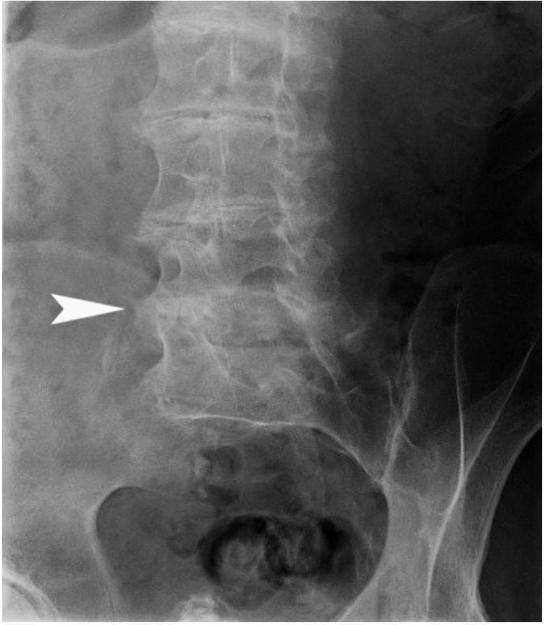 This diagnostic image is an anteroposterior (AP) X-ray radiograph of the lower lumbar spine and pelvis, demonstrating characteristic musculoskeletal manifestations of alkaptonuria (ochronosis). The image reveals severe, multi-level degenerative disc disease characterized by significant narrowing of the intervertebral disc spaces. A hallmark finding is the presence of dense, linear radiopaque calcifications within the intervertebral discs, indicated specifically by a white arrowhead at the L4-L5 level. Despite the advanced disc space narrowing and calcification, there is a notable absence of prominent marginal osteophytes, which is a classic radiographic sign distinguishing ochronotic arthropathy from standard age-related osteoarthritis. Additional findings include irregularity of the vertebral endplates and evidence of facet joint degeneration. The pelvic structures, including the sacroiliac joints and superior pubic rami, are partially visualized at the bottom of the frame. This radiograph illustrates the progressive spinal involvement typical in patients with endogenous ochronosis, where metabolic accumulation of homogentisic acid leads to premature and severe connective tissue degradation.