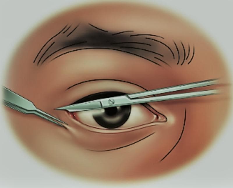 A medical illustration depicting the surgical procedure for a lateral canthotomy on a right human eye. The diagram shows the periorbital anatomy including the eyebrow, upper and lower eyelids, and the globe with a visible iris and sclera. Two primary surgical instruments are shown: a scalpel performing an initial incision at the lateral canthus (the outer corner of the eye) and iris scissors positioned to lengthen the incision. This procedure is clinically indicated for the emergency management of orbital compartment syndrome to rapidly reduce intraocular pressure and prevent optic nerve ischemia. The educational focus is on the correct anatomical placement of instruments relative to the lateral canthal tendon to achieve ocular decompression.