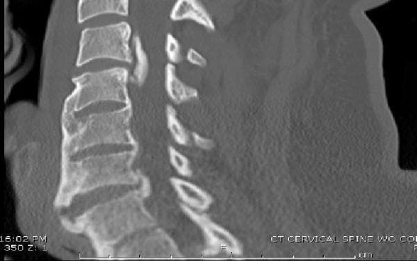 This sagittal CT scan of the cervical spine demonstrates findings consistent with diffuse idiopathic skeletal hyperostosis (DISH) and ossification of the posterior longitudinal ligament (OPLL). Extensive anterior autofusion is visible from C4 to T1, characterized by flowing ossification along the anterior aspect of the vertebral bodies. A prominent focal region of OPLL is identified at the C3-4 level, protruding into the spinal canal and narrowing the space for the spinal cord. Additionally, a distinct transverse lucency is observed through an anterior syndesmophyte at the C6-7 level, which may indicate a fracture or pseudoarthrosis. The vertebral bodies show preserved height, but the intervertebral disc spaces are obscured by the surrounding bony bridging. This image is medically significant for illustrating multi-level spinal stiffness and focal compressive pathologies that increase the risk of central cord syndrome following minor trauma. Target educational concepts include the radiographic identification of DISH, OPLL morphology, and the evaluation of spinal fractures in ankylosed spines.