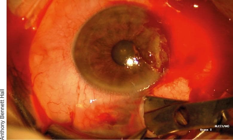 This clinical photograph captures an intraoperative view of an ophthalmological procedure, specifically the harvesting of a conjunctival autograft from the bulbar conjunctiva. The image shows the anterior segment of the human eye with a metallic surgical instrument, likely Westcott scissors, performing a plane dissection of a thin layer of conjunctival tissue off the underlying Tenon's capsule. The surgical site exhibits significant conjunctival injection and vascular engorgement, typical of perioperative inflammation. The corneal surface shows irregularities on the nasal side, consistent with the recent excision of a pterygium. This visual demonstrates key steps in pterygium surgery with autografting, focusing on the identification of the correct tissue plane to ensure a thin, Tenon-free graft. The clinical relevance lies in teaching surgical techniques for ocular surface reconstruction and the prevention of pterygium recurrence through meticulous tissue handling and graft preparation.