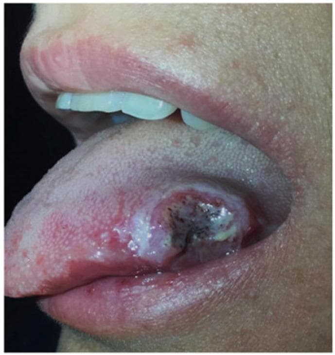 This clinical photograph displays a large, solitary aphthous ulcer on the lateral border and dorsal surface of the tongue in a patient with Crohn's disease. The lesion is characterized by a central necrotic base covered with a yellowish-white fibrinopurulent pseudomembrane and dark, irregular punctate areas. The ulcer has well-defined, raised, and intensely erythematous borders, forming a classic inflammatory halo. The surrounding lingual mucosa exhibits significant erythema and localized swelling, indicating secondary inflammation. Such oral manifestations are recognized as extraintestinal manifestations of inflammatory bowel disease (IBD), specifically Crohn's disease, and may correlate with systemic disease activity. This image serves as an educational example of aphthous stomatitis for gastroenterology and oral pathology, highlighting the importance of intraoral examination in the diagnosis and management of systemic inflammatory conditions.