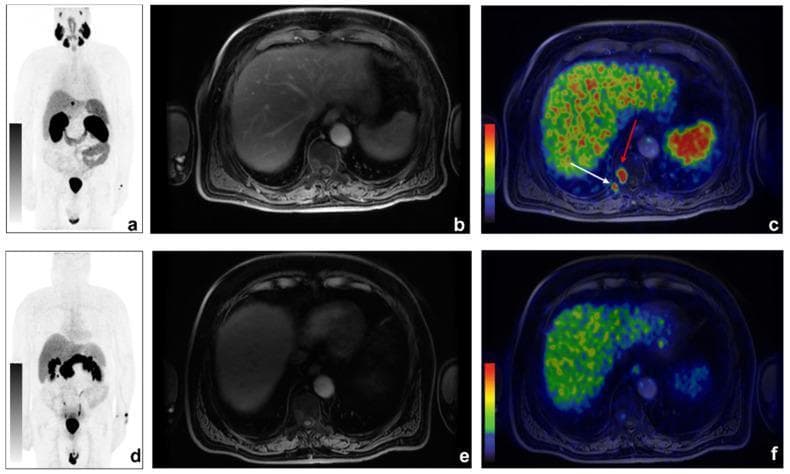 This comparative diagnostic series displays dual-tracer imaging for prostate cancer metastasis detection using 68Ga-PSMA and 68Ga-DOTA-RM2 PET/MRI. The top row (a-c) highlights 68Ga-PSMA findings: the Maximum Intensity Projection (MIP) (a) and axial fusion PET/MRI (c) reveal intense focal radiotracer uptake in the right D10 vertebral body (red arrow) and the posterior segment of the tenth rib (white arrow), consistent with bone metastases. The axial LAVA-FLEX MRI (b) provides high-resolution anatomical context of the upper abdomen, including the liver and spine. In contrast, the bottom row (d-f) displays 68Ga-DOTA-RM2 PET/MRI results for the same anatomical levels. While the anatomical MRI (e) is identical, the 68Ga-DOTA-RM2 MIP (d) and axial fusion (f) show no significant tracer accumulation in the corresponding osseous regions. This comparison demonstrates a discordant finding where PSMA-PET/MRI successfully identifies metastatic bone involvement that is not detectable by the GRPR-targeted 68Ga-DOTA-RM2 tracer, illustrating the varying diagnostic sensitivities of molecular targets in biochemical recurrence of prostate cancer.