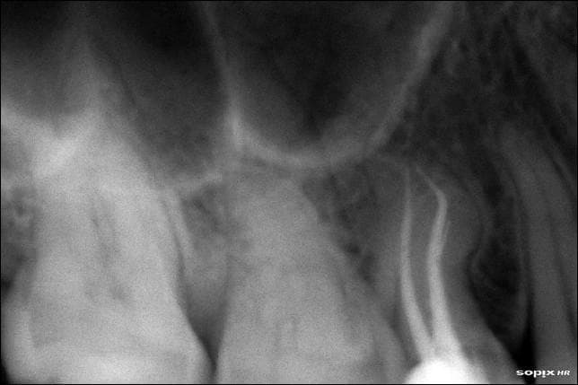 A periapical dental radiograph of the maxillary right posterior region, specifically showcasing a maxillary premolar post-endodontic treatment. The image demonstrates root canal obturation using radiopaque filling material (likely gutta-percha). Two distinct root canals (buccal and palatal) are visible, showing a complete, homogenous seal extending to the anatomical apices. The buccal canal exhibits a singular distal curvature, while the palatal canal shows a characteristic S-shaped or complex curvature that was successfully negotiated and filled. The surrounding alveolar bone shows a normal trabecular pattern with a well-defined lamina dura and no evidence of periapical radiolucency, indicating the absence of inflammatory lesions. The maxillary sinus floor is visible superior to the root apices. This diagnostic image serves as an educational example of successful complex root canal anatomy management and obturation using the lateral compaction technique.