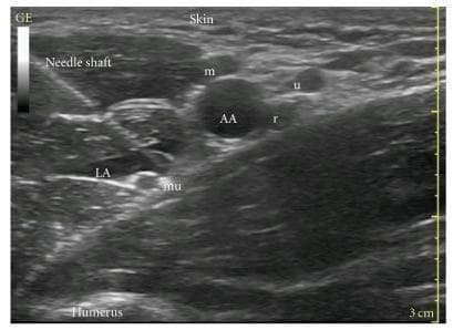 This clinical diagnostic image is a transverse grayscale ultrasound scan of the axillary region, demonstrating the anatomy for an axillary brachial plexus block. Centrally, the axillary artery (AA) appears as a prominent anechoic (black), circular vascular structure. Surrounding the artery are the terminal branches of the brachial plexus: the median nerve (m) is located superior to the artery, the ulnar nerve (u) is positioned superior and slightly lateral, and the radial nerve (r) is located posterior-inferior to the artery. The musculocutaneous nerve (mu) is visualized separately, lateral to the main neurovascular bundle within the fascial plane of the coracobrachialis muscle. A hyperechoic (bright), linear needle shaft is seen using an in-plane approach, extending from the superficial tissue toward the deeper structures. A pocket of hypoechoic local anesthetic (LA) is visible near the needle tip, indicating active infiltration. Deep landmarks include the hyperechoic cortex of the humerus at the bottom of the frame. This image serves as an educational guide for regional anesthesia, illustrating needle-beam alignment and the spatial relationship of nerves to the axillary artery.