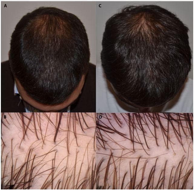 This composite image illustrates the progression of Androgenetic Alopecia (AGA) treatment in a 31-year-old male over a six-month interval. Panels A and C are clinical photographs of the scalp from a vertex view. Panel A (baseline) shows characteristic male-pattern hair loss with significant thinning at the vertex and recession in the frontal-temporal region. Panel C (6-month follow-up) demonstrates clinical improvement with increased hair density and improved scalp coverage in the same regions. Panels B and D provide high-magnification trichoscopic views of the scalp. Panel B (baseline) displays hair shaft diameter diversity (anisotropy) and several miniaturized hairs, which are hallmark diagnostic features of AGA. Panel D (post-treatment) reveals a notable increase in hair follicle density and a higher proportion of terminal hairs compared to miniaturized ones, indicating a positive therapeutic response. This comparison serves as a diagnostic and monitoring tool in dermatology, highlighting the role of trichoscopy in assessing hair shaft diameter and follicular unit density.