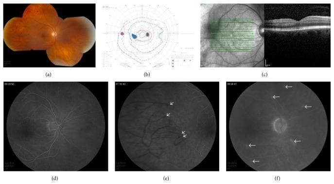 Multi-panel clinical diagnostic series illustrating ischemic hemorrhagic retinal vasculitis. Panel (a) is a color fundus montage showing significant arteriolar narrowing (attenuation), peripheral retinal pallor, and scattered dot-blot hemorrhages. Panel (b) depicts a Goldmann visual field with central isopter constriction, an enlarged blind spot, and a paracentral scotoma. Panel (c) provides a cross-sectional optical coherence tomography (OCT) scan showing preserved architecture of the retinal layers including the nerve fiber and photoreceptor layers. Panels (d–f) present a fluorescein angiography (FA) sequence: (d) illustrates delayed retinal and choroidal filling in the mid-phase; (e) demonstrates extensive late-phase peripheral capillary non-perfusion and terminal arteriolar occlusions (white arrows); (f) highlights scattered focal areas of vessel wall hyperfluorescence and leakage (white arrows). The findings are consistent with vancomycin-induced hemorrhagic occlusive retinal vasculitis (HORV) following intraocular surgery, focusing on severe peripheral ischemia despite a relatively normal posterior pole appearance on OCT.