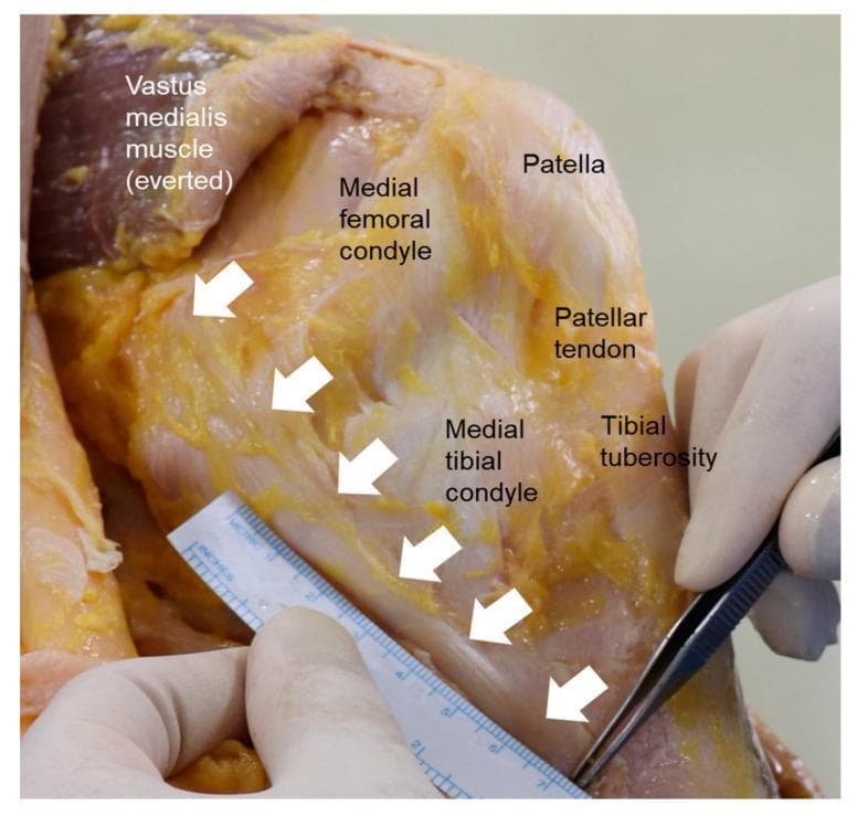 This clinical photograph displays a gross anatomical dissection of the medial aspect of a human knee joint, demonstrating the primary capsuloligamentous structures. The Medial Collateral Ligament (MCL) is highlighted by a series of white arrows, tracing its path from the medial femoral condyle to its distal insertion on the medial tibial condyle. The surrounding anatomy is clearly labeled: the everted vastus medialis muscle is visible superiorly, alongside the patella and the patellar tendon extending toward the tibial tuberosity. The image demonstrates the layered anatomical organization of the knee (Warren and Marshall’s layers), specifically focusing on the Layer II superficial MCL. In the foreground, surgical instrumentation including a metric ruler and fine-tipped forceps are used to measure the longitudinal dimension of the ligament fibers. This visual serves as an educational reference for orthopedic surgery and anatomy, illustrating the relationship between the major medial stabilizers of the knee and their bony landmarks during a surgical or cadaveric study.