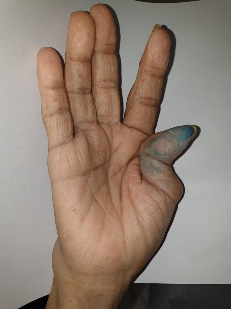 This clinical photograph displays the palmar surface of a right hand, primarily illustrating a classic 'Z-thumb' deformity (Hitchhiker thumb), a hallmark sign frequently associated with advanced rheumatoid arthritis. The deformity is characterized by severe flexion at the metacarpophalangeal (MCP) joint and compensatory hyperextension at the interphalangeal (IP) joint. There is also evident bony swelling and ulnar deviation at the wrist. While the distal interphalangeal (DIP) joints of the digits appear relatively spared, there is subtle swelling suggestive of polyarthropathy in the proximal regions. The thumb's skin shows a blue discoloration, likely from diagnostic marking or external staining. This image serves as an educational example of chronic inflammatory joint destruction and secondary ligamentous laxity leading to fixed musculoskeletal deformities in systemic autoimmune conditions.