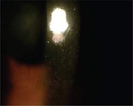 This clinical photograph shows a slit-lamp examination of the anterior segment of a human eye, focusing on the cornea. The image demonstrates a characteristic clinical finding of anterior uveitis: keratic precipitates (KP). These appear as diffuse, medium-sized, brownish-gray inflammatory cellular deposits adhered to the posterior surface of the cornea (the corneal endothelium). The precipitates are distributed across the illuminated area, contributing to visible endothelial haziness. The light reflex from the slit lamp is scattered and irregular, indicating a disruption of corneal clarity and the presence of inflammatory material. This finding is highly relevant for diagnosing intraocular inflammation and monitoring the response to therapy in conditions like viral or idiopathic uveitis.