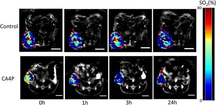 This composite diagnostic image displays Multispectral Optoacoustic Tomography (MSOT) scans of a lung xenograft tumor model in a mouse. The panel compares a control group (top row) with a CA4P-treated group (bottom row) at four time points: 0h, 1h, 3h, and 24h. The pseudocolor overlay represents hemoglobin oxygen saturation (%SO2) on a scale from 0% (dark blue/black) to 80% (bright red). Red indicates high oxyhemoglobin levels, while blue represents deoxyhemoglobin or blood-deficient areas. In the control group, the tumor exhibits persistent heterogeneous oxygenation (mixed red and blue) throughout the 24-hour period. In the CA4P group, the tumor undergoes a dramatic shift from high baseline oxygenation at 0h to a predominantly blue signal at 1h, 3h, and 24h. This visual transition demonstrates the pharmacodynamic effect of Combretastatin A-4 phosphate (CA4P) as a vascular disrupting agent (VDA), illustrating immediate and sustained vascular shutdown, resulting in acute tumor hypoxia and reduced perfusion. Scale bars represent 5 mm.