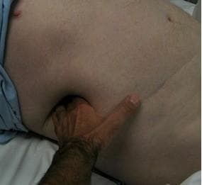 This clinical photograph illustrates a physical examination of a large, reducible Traumatic Transdiaphragmatic Intercostal Hernia (TTIH) in a supine patient. The image shows a significant bulging deformation in the right abdominal and lower thoracic wall region. A clinician's hand is shown applying manual pressure directly onto the herniation, demonstrating its easy reducibility as the abdominal wall yields to the touch. The overlying skin appears intact without signs of acute inflammation or discoloration. This visual focuses on the clinical manifestation of a post-traumatic defect in the abdominal wall and diaphragm, where abdominal viscera (typically including the liver or colon) herniate through the intercostal space. The image is an educational example of hernia assessment techniques and the gross appearance of a chronic traumatic hernia during follow-up.