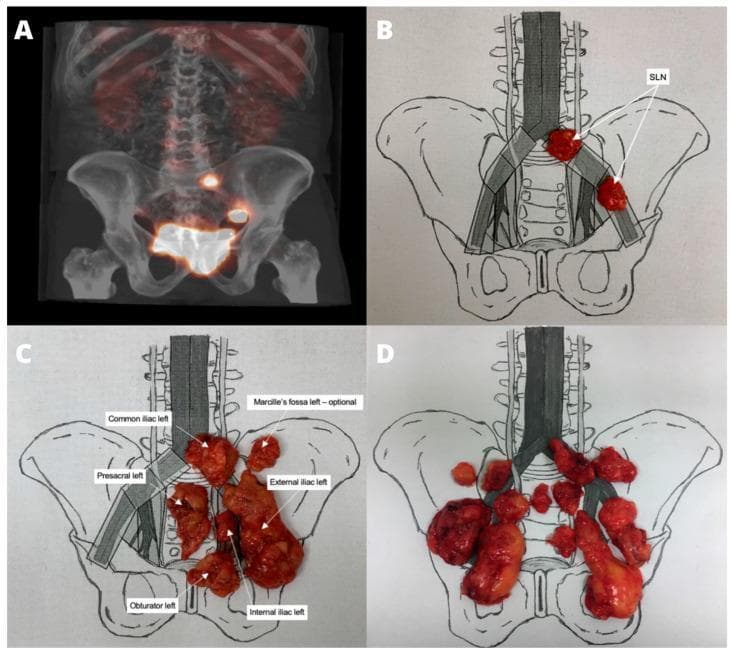 This composite educational image illustrates the methodology for pelvic lymph node (LN) mapping in patients with muscle-invasive bladder cancer (MIBC). (A) Shows a SPECT-CT fusion image demonstrating the anatomical localization of radioactive sentinel lymph nodes (SLNs) within the pelvic cavity. (B) A schematic diagram of the pelvic anatomy and iliac vessels serves as a template, where two identified SLNs are mapped as reddish, irregular masses on one side. (C) Displays macroscopic lymphadenectomy specimens (resected fatty tissue and lymph nodes) placed onto the pelvic template and labeled by their specific anatomical drainage regions, including common iliac, external iliac, internal iliac, obturator, presacral, and Marcille’s fossa. (D) Shows the full range of resected pelvic lymphadenectomy specimens grouped by anatomical region. This figure demonstrates the workflow from nuclear imaging localization to surgical resection (super-extended pelvic lymph node dissection) and pathological mapping, highlighting the precision required for oncological staging and treatment planning.