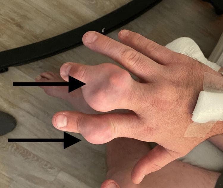 Clinical photograph of the dorsal aspect of a right hand demonstrating chronic tophaceous gout. The image prominently features two large, nodular, firm swellings (tophi) located at the distal interphalangeal (DIP) and proximal interphalangeal (PIP) joint regions of the second (index) and third (middle) digits, highlighted by black arrows. The larger mass on the index finger appears bulbous and irregular, with the overlying skin appearing thin, taut, and slightly erythematous or translucent, characteristic of underlying monosodium urate crystal deposition. Proximal to the metacarpophalangeal joints, a white medical dressing is visible on the wrist area, suggesting recent clinical intervention or intravenous access. The photograph illustrates advanced manifestations of gouty arthritis, emphasizing the typical presentation of tophi in the small joints of the hand. The clinical significance lies in identifying chronic hyperuricemia complications and distinguishing these masses from other rheumatological conditions like rheumatoid nodules or osteoarthritis-related Heberden's and Bouchard's nodes.