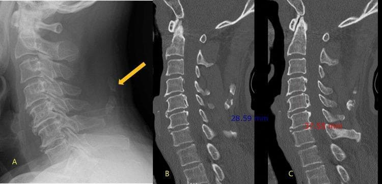 This composite diagnostic image displays a lateral cervical spine radiograph (A) alongside sagittal reconstructed CT scans (B, C) of a 60-year-old male. Image A demonstrates a focal radiopaque density within the posterior soft tissues (indicated by a yellow arrow), consistent with ossification of the nuchal ligament (ONL), while deeper structures like the posterior longitudinal ligament are obscured by overlying bone. CT image B provides a detailed sagittal view of this ONL, measuring its longitudinal extent from C4 to C5 at 2.9 cm. CT image C reveals a separate, clinically significant pathology: ossification of the posterior longitudinal ligament (OPLL), which presents as a continuous hyperdense strip along the posterior margins of the C4 to C6 vertebral bodies, measuring 3.8 cm. This comparison emphasizes the diagnostic superiority of CT over plain radiography for identifying OPLL, which may be masked on X-rays by the spinal column, and highlights the importance of further imaging when superficial ligamentous ossification is detected.