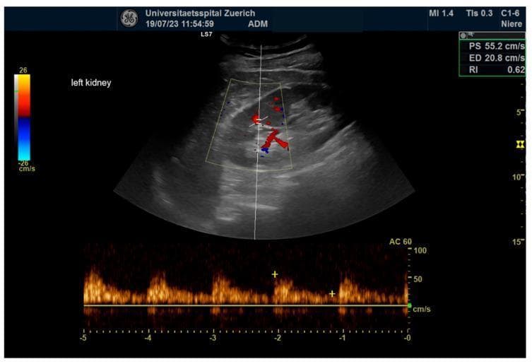 This diagnostic image shows a color-coded duplex sonography (ultrasound) of a left kidney, focusing on renal hemodynamics. The upper panel displays a grayscale B-mode image of the kidney with a color Doppler overlay showing the vascular arborization; red indicates blood flow toward the transducer and blue away from it. The lower panel features a spectral Doppler waveform indicating velocity over time. The waveform exhibits a pulsatile flow pattern typical of renal arterial circulation, characterized by a rapid systolic upstroke and continuous diastolic flow. Key hemodynamic measurements are displayed in the upper right corner: Peak Systolic Velocity (PS) of 55.2 cm/s, End-Diastolic Velocity (ED) of 20.8 cm/s, and a calculated Renal Resistance Index (RI) of 0.62. This RI value is within the normal physiological range (typically <0.70), suggesting normal vascular resistance and parenchymal health. This image is an educational example of monitoring renal perfusion and vascular resistance using non-invasive duplex sonography in a clinical setting.