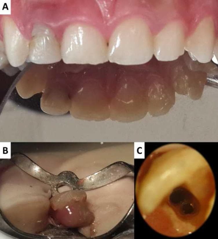 This composite intraoral image sequence documents an endodontic retreatment of the maxillary right lateral incisor (tooth #12). Image A presents a clinical facial view and a palatal mirror reflection of the anterior teeth, showing cervical discoloration, a mesial carious lesion, and a palatal composite restoration on tooth #12. Image B depicts the tooth under rubber dam isolation during endodontic access; it demonstrates purulent exudate (pus discharge) emerging from the access cavity following the removal of failing gutta-percha filling material, indicating symptomatic apical periodontitis. Image C provides a high-magnification view through a dental operating microscope, revealing the internal anatomy of the pulp chamber. The magnification highlights the presence of two distinct root canals—a labial canal and a palatal canal—which is an anatomical variation for this tooth type. The sequence illustrates the clinical presentation, infectious complications, and microscopic identification of missed canal anatomy during endodontic therapy.