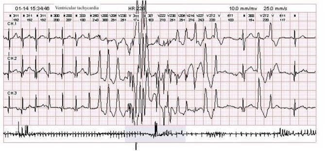 This diagnostic image is a 24-hour Holter monitoring ECG strip showing a transient episode of ventricular tachycardia (VT). The tracing is organized into three simultaneous channels (CH.1, CH.2, and CH.3) displaying cardiac electrical activity. The central portion of the strip captures a paroxysm of wide-complex tachycardia with a recorded heart rate (HR) of 225 bpm. The ventricular complexes exhibit marked pleomorphism (varying morphologies) and irregular R-R intervals, indicating a non-sustained, unstable ventricular rhythm. Preceding and following the VT episode, the tracing shows a return to a slower, more regular baseline rhythm with narrow QRS complexes, though some premature ventricular contractions are visible. Annotations at the top of the strip provide numerical data for R-R intervals and heart rate. This visual is clinically significant for demonstrating malignant arrhythmias that can occur post-seizure, serving as an educational example of polymorphic ventricular tachycardia and the transition from sinus rhythm to ventricular arrhythmia.