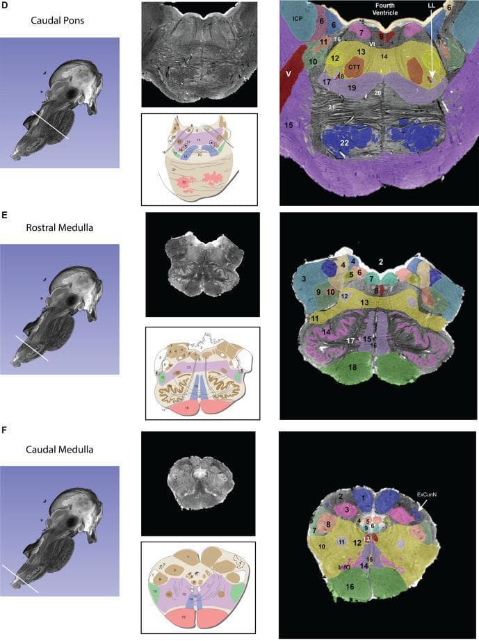 This diagnostic comparison chart provides high-resolution axial MRI sections and corresponding anatomical schematics of the human brainstem at three levels: the caudal pons (D), rostral medulla (E), and caudal medulla (F). Each row contains a sagittal reference view indicating the slice plane, a raw T2-weighted axial MRI, a corresponding labeled anatomical diagram, and a color-coded segmented MRI overlay. Key neuroanatomical structures identified include the fourth ventricle, middle and inferior cerebellar peduncles (MCP, ICP), facial motor nucleus, abducens nucleus, and the inferior olivary nucleus. In the caudal pons, the broad basilar part and large middle cerebellar peduncles are prominent. Progressing caudally into the medulla, the sections transition to a more rounded morphology, highlighting the emergence of the pyramids, the inferior olives, and dorsal column nuclei such as the nucleus gracilis and cuneatus. This resource is designed for advanced neuroanatomical education, facilitating the correlation between clinical imaging modalities and theoretical structural maps to aid in the identification of nuclei and fiber tracts.