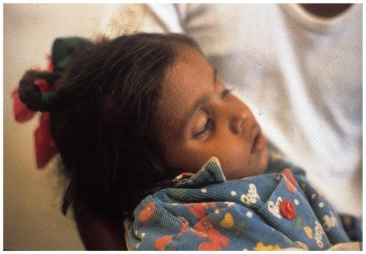 This clinical photograph displays a young child exhibiting classic signs of severe dehydration, likely secondary to acute watery diarrhea. The primary visual finding is the presence of deeply sunken eyes (enophthalmos), a critical physical marker of significant fluid volume deficit. The child demonstrates a depressed level of consciousness, appearing obtunded or lethargic with eyes closed and a lack of responsiveness to the surrounding environment. The facial features appear pinched, and there is a suggestion of reduced tissue turgor. This image serves as an educational tool for identifying the clinical 'danger signs' of dehydration in pediatric patients, emphasizing the need for urgent fluid resuscitation, such as intravenous therapy or intensive oral rehydration salts (ORS) protocols. The context suggests a global health setting where monitoring and managing electrolyte balance is vital for survival in cases of severe diarrheal illness.