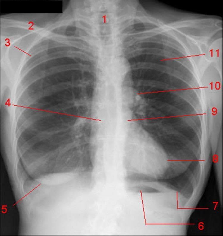 This diagnostic image is a posteroanterior (PA) chest X-ray of a healthy adult, serving as an anatomical diagram of the thorax. The radiograph displays key structures labeled for educational purposes: the trachea (1) appears as a vertical radiolucent (dark) air column in the midline; the clavicle (2) is a dense radiopaque bone at the superior margin; and the posterior portion of the fourth rib (3) is visible in the upper lung field. Lower down, the right main bronchus (4) branches from the carina. Soft tissue features include the lower margin of the right breast (5). The abdomen-thorax interface highlights the gastric air bubble (6) beneath the left diaphragmatic dome (7). The cardiac silhouette is represented by the left ventricle (8), while the descending aorta (9) and left pulmonary artery (10) are seen in the mediastinum and hilum. The left lung (11) exhibits normal radiolucency. This image demonstrates standard radiographic anatomy, spatial relationships of mediastinal structures, and common landmarks used in clinical imaging and diagnostic triage.