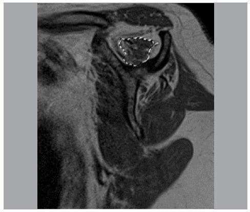 This diagnostic image is a T1-weighted oblique sagittal MRI of the shoulder, specifically at the level where the scapular spine is continuous with the scapular body, forming a characteristic 'Y' shape. The image demonstrates the cross-sectional anatomy of the rotator cuff muscles. Fat is visualized with high signal intensity (bright white), while the muscle tissue shows intermediate signal intensity (gray). A white dotted line is used as an annotation to trace the area of the supraspinatus muscle belly within the supraspinatus fossa. This specific slice and tracing method are clinically relevant for assessing muscular trophism and fatty infiltration, often utilized in the evaluation of rotator cuff tears and postoperative recovery. Key visible structures include the supraspinatus, infraspinatus, and subscapularis muscles, providing a clear view for volumetric and qualitative analysis of muscle mass.