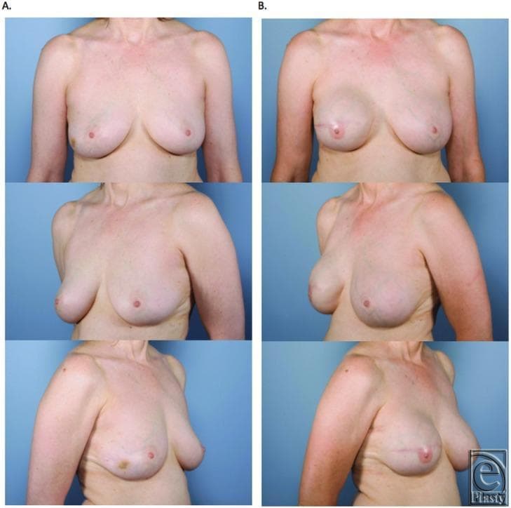 This clinical comparison photograph displays a patient before and after a unilateral skin-sparing mastectomy and immediate breast reconstruction. Column A (Preoperative) shows three views (anterior, left oblique, and right lateral) of natural breast anatomy with moderate ptosis and slight asymmetry, where the left nipple is positioned inferiorly. Column B (Postoperative) demonstrates the results after an expander-to-implant exchange utilizing Gore-Tex (Gore DualMesh) for lower-pole support. The reconstructed breast exhibits improved volume, a more rounded contour, and a superiorly repositioned nipple-areola complex compared to the preoperative state. Visible surgical markers include a transverse scar on the mid-to-lower pole of the reconstructed breast and a scar along the inframammary fold. These images illustrate the aesthetic outcomes of synthetic mesh-assisted breast reconstruction, highlighting the restoration of symmetry and upper body contour in the context of oncoplastic surgery.