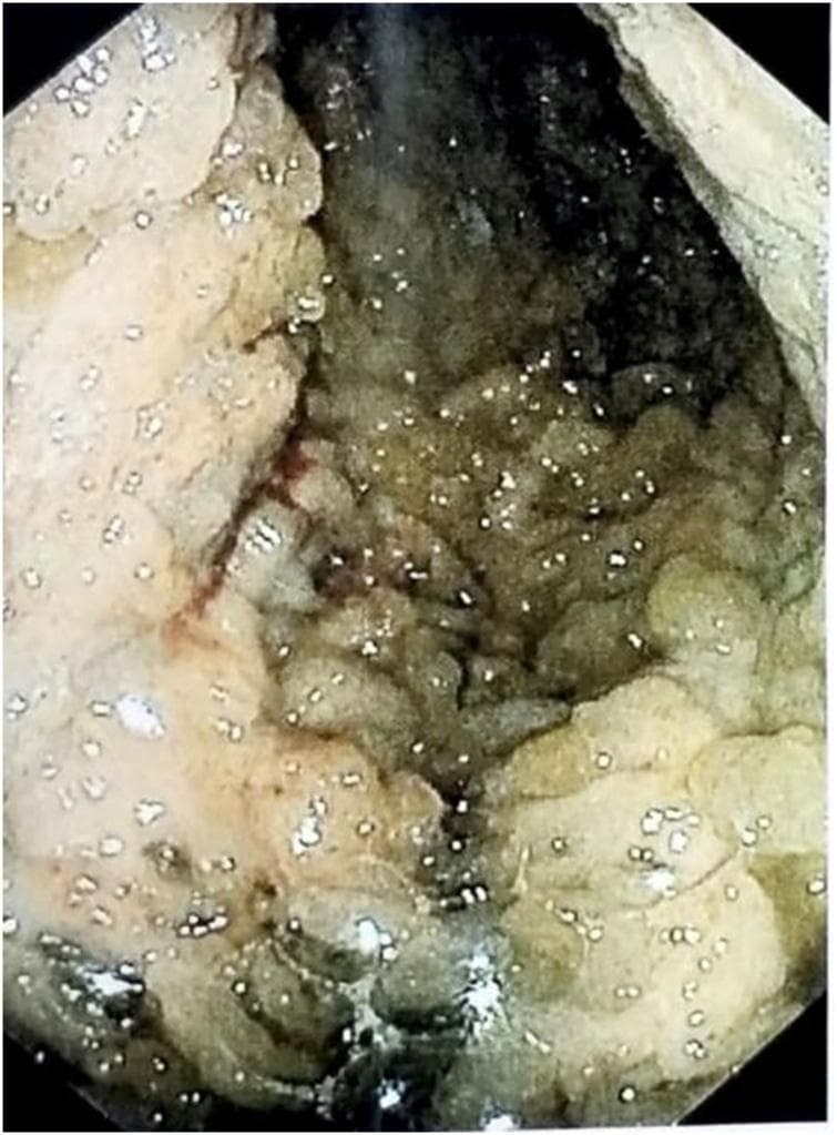 This clinical photograph displays a preoperative upper endoscopy of the stomach, demonstrating hallmark features of Menetrier's disease. The image reveals massive, cerebriform (brain-like) enlargement of the gastric rugae, specifically involving the fundus and body of the stomach. These hypertrophied folds appear thick, convoluted, and edematous, significantly narrowing the gastric lumen. The mucosa exhibits a variegated color palette, ranging from pale beige to brownish-green, with a moist, reflective surface texture likely caused by excessive mucus production (foveolar hyperplasia). Small, bright reflective spots across the tissue surface indicate the presence of fluid or mucous film. A localized area of linear erythema is visible, suggesting capillary congestion or minor mucosal erosion. The visual evidence of extreme mucosal thickening correlates with the clinical presentation of protein-losing gastropathy, hypoalbuminemia, and cachexia, providing a classic endoscopic example of hypertrophic gastropathy.