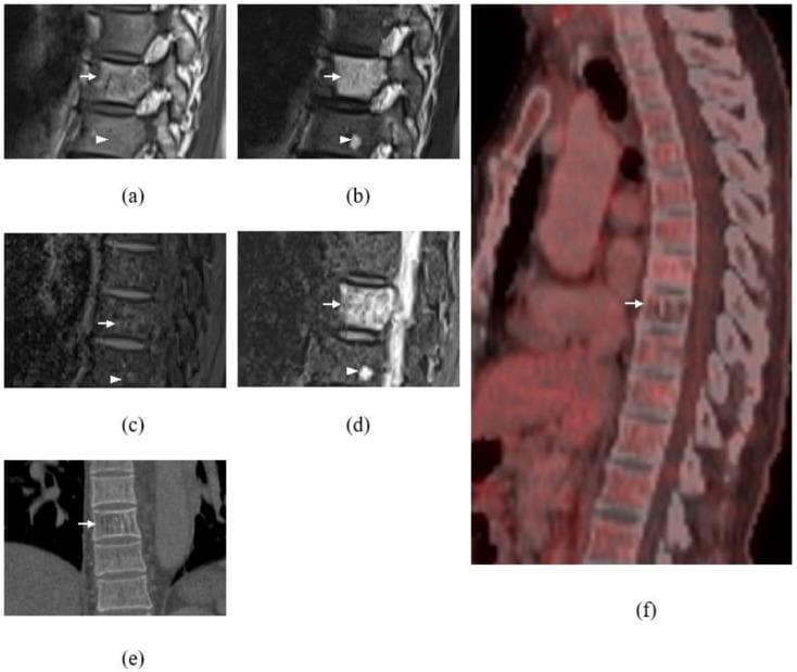 This composite educational image features multi-modal diagnostic imaging of the thoracic spine, focusing on vertebral body lesions at T9 and T10.
