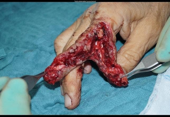 Clinical photograph of a severe traumatic injury to the index finger of a 69-year-old patient, following a circular saw accident. The image shows an extensive, longitudinal open wound and partial amputation involving the middle (P2) and distal (P3) phalanges. There is significant destruction and loss of skin, subcutaneous tissue, and deeper structures. The wound exhibits irregular, macerated edges with visible exposure of bone fragments and likely tendon or neurovascular damage. Surgical forceps and a retractor are shown manipulating the tissues to assess the extent of the damage during primary soft tissue management. The surrounding skin of the hand appears relatively intact, although localized ecchymosis and active hemorrhage are present within the injury site. This visual illustrates a high-energy hand trauma scenario that necessitates complex surgical intervention, ultimately resulting in proximal interphalangeal (PIP) joint exarticulation and stump formation.