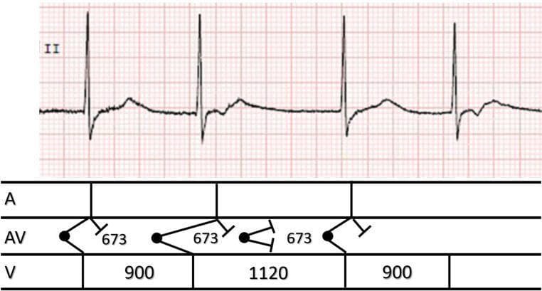 This diagnostic image contains a single-lead electrocardiogram (ECG) rhythm strip from lead II, paired with a corresponding ladder diagram to illustrate cardiac conduction. The ECG demonstrates group beating with variable R-R intervals (900ms and 1120ms), absence of normal sinus P waves, and the presence of retrograde P waves (inverted deflections following the QRS complexes). The visual evidence points to a junctional rhythm with retrograde atrial conduction and occasional reciprocal (echo) beats. The ladder diagram below the tracing provides a schematic representation of conduction across three levels: Atria (A), Atrioventricular node (AV), and Ventricles (V). It specifically denotes timing intervals (673ms, 900ms, 1120ms) and uses standard symbols to indicate points of origin (dots), antegrade and retrograde conduction pathways (angled lines), and conduction block (perpendicular bars). This material is designed for intermediate to advanced cardiovascular education, specifically focusing on complex arrhythmia interpretation and the electrophysiological mechanism of re-entrant junctional rhythms.