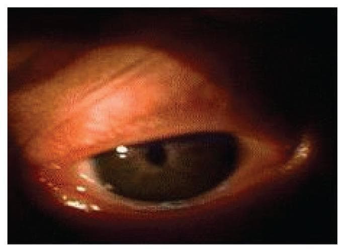 A clinical photograph focusing on the left eye of an infant, demonstrating microcoria. The primary finding is a pathologically small, pinpoint pupil (miosis) that is centrally positioned within the iris. The iris appears dark brown and occupies most of the visible corneal area due to the extreme pupillary constriction. The sclera shows some mild periorbital erythema along the eyelid margins, while the palpebral fissure appears narrowed. This visual finding is a hallmark ocular manifestation of Pierson syndrome (congenital nephrotic syndrome with ocular abnormalities), representing a fixed, non-reactive pupil. The image serves as an educational example of congenital ocular pathology and its association with systemic multi-organ syndromes in pediatric patients.