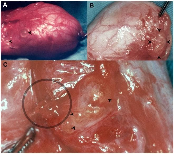 This composite of three clinical photographs (A, B, and C) illustrates surgical findings of scrotal filariasis caused by Wuchereria bancrofti. Image A shows an emptied hydrocele sac with multiple small, translucent, round dilations of the lymphatic vessels (lymphangiectasias) visible on the outer serosal surface. Image B demonstrates similar lymphangiectasias in the retrotesticular area near the excision margin following a hydrocelectomy. Image C provides a high-magnification view of a cluster of these dilated lymphatics. Through the semi-transparent walls of the largest lymphangiectasia, elongated, filiform (thread-like) white structures are visible, representing adult W. bancrofti worms. These findings highlight the characteristic lymphatic pathology of bancroftian filariasis, where adult parasites reside within and cause focal dilation of the scrotal lymphatic system. The images serve as an educational resource for identifying gross pathological features of parasitic lymphatic disease during surgical procedures for hydrocele.
