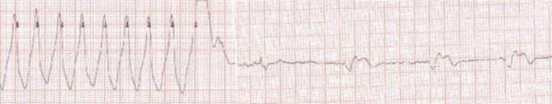 This EKG tracing illustrates the transition from a life-threatening arrhythmia to a paced rhythm following synchronized DC cardioversion. The left portion of the strip displays a monomorphic ventricular tachycardia (VT), characterized by a rapid, regular rhythm (approximately 200 beats/min) with wide, uniform QRS complexes. In the middle of the strip, a distinct high-amplitude deflection signifies the delivery of a 120J biphasic DC shock. Post-cardioversion, the tracing on the right reveals a transition into a slower rhythm (60 beats/min). The wide, regular complexes in the post-shock phase, preceded by sharp vertical pacing spikes, indicate that the patient's intrinsic heart rhythm has been superseded by a ventricular pacemaker. This visual sequence is a classic clinical demonstration of successful electrical conversion of sustained VT in a patient with an implanted cardiac device. It highlights key concepts in advanced cardiac life support (ACLS), arrhythmia management, and medical device interaction in the post-arrest or peri-procedural setting.