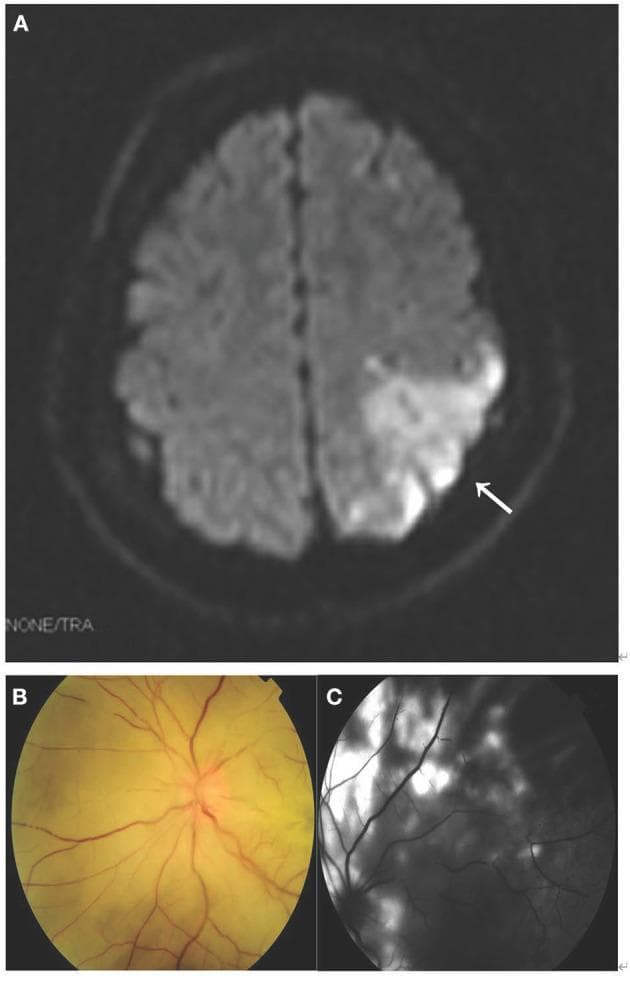 This composite clinical figure illustrates multi-organ pathology related to fat embolism syndrome. Panel A shows an axial Diffusion-Weighted MRI (DWI) of the brain, highlighting a hyperintense signal in the left parietal lobe (marked with an arrow), consistent with an acute ischemic stroke. Panel B is a fundus photograph showing an edematous optic disc, generalized retinal whitening, and a pale yellow posterior pole, indicative of retinal ischemia. Segmental occlusions within the retinal arterioles represent visible fat emboli. Panel C displays fluorescein angiography (FA) of the same eye, demonstrating significant hypofluorescent areas that correspond to vascular blockage and a lack of capillary perfusion in the retinal tissue bed. This combination of neuroimaging and ophthalmologic findings demonstrates systemic embolic phenomena affecting both the cerebral and ocular microcirculation, typically seen in clinical scenarios involving trauma or fat embolism syndrome.