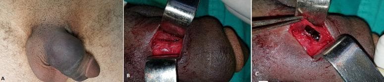 This composite of three clinical and intraoperative photographs illustrates a penile fracture resulting from blunt trauma. Image A shows a clinical photograph of the external genitalia exhibiting the classic 'eggplant deformity,' characterized by significant edema, ecchymosis, and deep purple discoloration of the penile shaft due to subcutaneous hematoma. Images B and C are intraoperative photographs taken during surgical exploration. Image B displays a longitudinal tear or rupture in the tunica albuginea of the right corpus cavernosum, exposed via a surgical incision and maintained with metallic retractors. Image C demonstrates the evacuation of a localized hematoma and the associated inflammatory response of the underlying cavernous tissue. This sequence is representative of the diagnostic presentation and surgical management of urological emergencies involving traumatic rupture of the tunica albuginea.