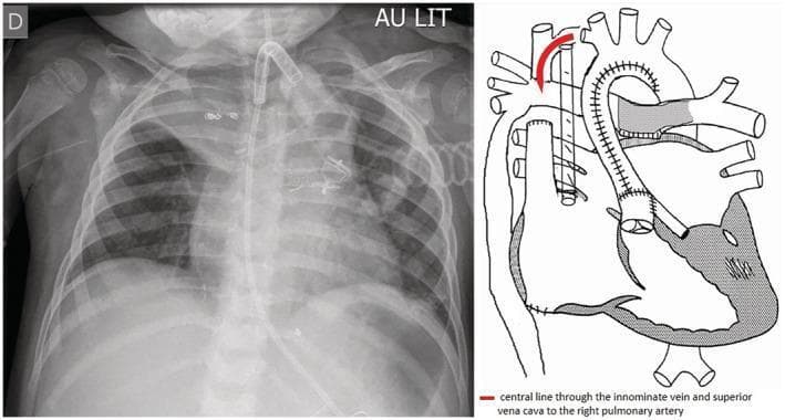 Anteroposterior (AP) chest radiograph and corresponding anatomical diagram demonstrating the trajectory of a peripherally inserted central catheter (PICC) in a pediatric patient with complex congenital heart disease. The radiograph shows a tracheostomy tube and several radiopaque surgical clips in the upper mediastinum. A radiopaque catheter enters from the left peripheral vasculature, coursing medially through the left innominate vein into the superior vena cava (SVC). Uniquely, due to a Fontan anastomosis (depicted in the adjacent diagram), the catheter passes directly from the SVC into the right pulmonary artery (RPA) rather than the right atrium. This specific positioning allows for direct monitoring of pulmonary arterial pressures. The anatomical diagram clarifies the post-surgical cardiovascular geometry, with a red arrow highlighting the path from the systemic venous return to the pulmonary circulation, bypassing the ventricle. The lungs, ribs, and clavicles serve as anatomical landmarks for verifying the catheter's mediastinal path and distal tip placement within the pulmonary vasculature.