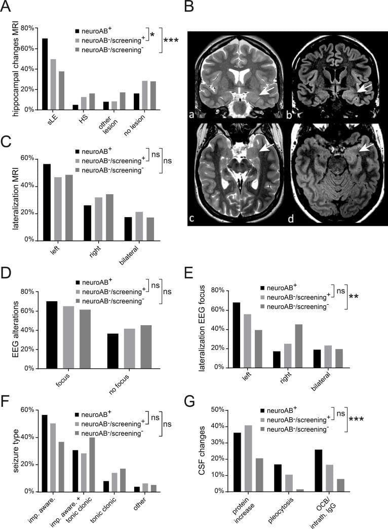 Educational medical graphic combining diagnostic imaging and comparative clinical data regarding autoimmune encephalitis. Panel B presents four MRI brain scans of a patient with anti-GAD65 limbic encephalitis. Coronal T2-weighted (a) and FLAIR (b) images, along with axial T2 (c) and FLAIR (d) images, demonstrate unilateral swelling and hyperintensity of the left hippocampus (white arrows) compared to the normal contralateral right side, signifying acute inflammatory edema. Panels A, C, D, E, F, and G consist of bar graphs stratifying patients into three groups based on neural antibody status (neuroAB+, neuroAB-/screening+, and neuroAB-/screening-). These charts compare clinical parameters including MRI hippocampal findings (sLE, HS, other), MRI and EEG lateralization, presence of EEG foci, seizure types (focal impaired awareness, tonic-clonic), and cerebrospinal fluid (CSF) inflammatory markers (protein levels, pleocytosis, oligoclonal bands). The data illustrates a higher frequency of limbic encephalitis-suspicious MRI changes and inflammatory CSF profiles in neuroAB+ patients compared to antibody-negative screening groups.