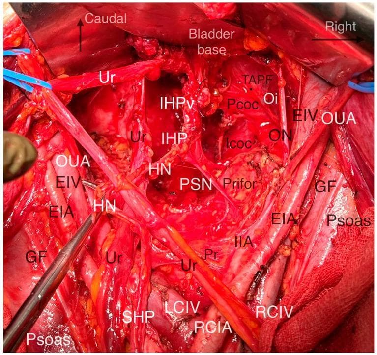 This clinical photograph shows a deep surgical dissection of the pelvic autonomic nervous system and surrounding anatomy during a nerve-sparing radical hysterectomy. The image illustrates the complex relationship between vascular, nervous, and muscular structures within the pelvic sidewall and floor. Key vascular landmarks include the External Iliac Artery (EIA) and Vein (EIV) running along the Psoas muscle, the Internal Iliac Artery (IIA), and the Common Iliac vessels near the Promontorium (Pr). The Pelvic Autonomic Nerve System (PANS) is highlighted centrally, featuring the Superior Hypogastric Plexus (SHP), Hypogastric Nerves (HN), Pelvic Splanchnic Nerves (PSN), and the Inferior Hypogastric Plexus (IHP) with its vesical branches (IHPv) extending toward the bladder base. The Ureter (Ur) is visible traversing the field, providing a critical landmark for surgical planes. Deep muscular structures of the pelvic floor, including the Piriformis (Prifor), Obturator Internus (Oi), and the levator ani components (Pcoc, Icoc), are clearly exposed. This visual serves as an educational resource for identifying anatomical landmarks essential for performing systematic nerve-sparing pelvic surgery.
