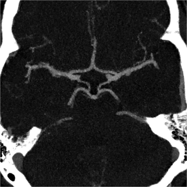 This diagnostic image is a 7 mm thick-slab axial maximum intensity projection (MIP) reconstructed from a brain magnetic resonance angiography (MRA). It demonstrates the complete and normal anatomical configuration of the Circle of Willis at the base of the brain. The primary vascular structures are clearly visualized, including the bilateral anterior cerebral arteries (ACA) joined by the anterior communicating artery (AComA), the bilateral middle cerebral arteries (MCA), and the posterior cerebral arteries (PCA) connected to the internal carotid circulation via patent posterior communicating arteries (PCoA). The basilar artery and its bifurcation are also evident. All arterial segments exhibit normal caliber (≥0.8 mm), smooth morphology, and continuous contrast enhancement without evidence of stenosis, aneurysm, or hypoplasia. This image serves as a clinical reference for a 'Group I' vascular classification, representing a fully intact and symmetrical cerebral arterial circle. It is highly relevant for neuroradiology education focusing on intracranial vascular anatomy and diagnostic imaging interpretation.