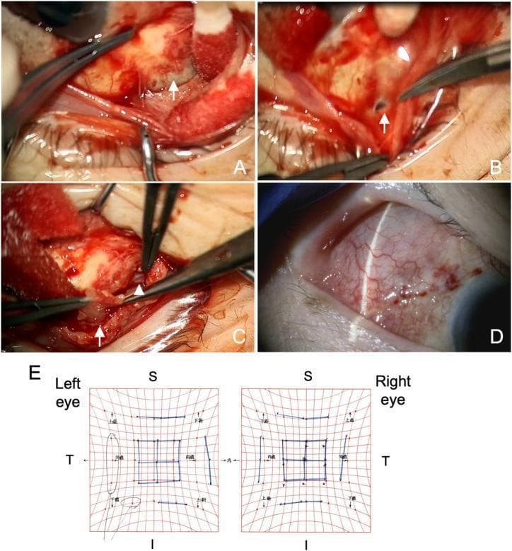 This composite educational graphic illustrates the surgical management and follow-up of a giant glaucoma bleb complication. Images A-C are intraoperative clinical photographs of the right eye: (A) demonstrates the debridement and separation of the fibrotic bleb wall from the overlying conjunctival tissue; (B) shows a surgical incision into the encapsulated bleb wall to facilitate drainage of accumulated aqueous humor; and (C) depicts the excision of the anterior bleb wall, revealing the underlying Ahmed Glaucoma Valve (AGV) plate (arrowhead). Image D is a postoperative slit-lamp biomicroscopy photograph of the superotemporal quadrant showing a normalized, diffuse bleb over the implant site with healthy conjunctival vascularity three weeks following the revision. Image E presents a Hess chart screen demonstrating bilateral orthophoria, confirming the resolution of preoperative diplopia and extraocular muscle restriction. This visual progression is characteristic of surgical bleb wall excision used to treat posteriorly enlarging giant blebs that cause ocular displacement and motility disturbances.
