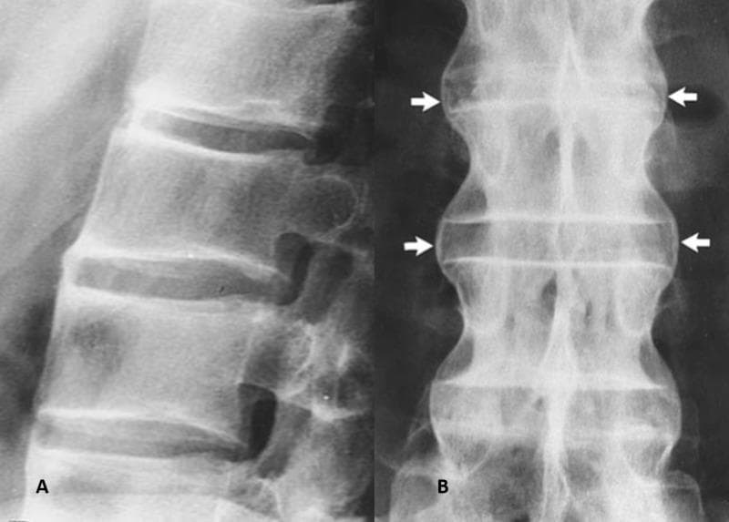 This diagnostic image consists of two radiographic views of the human spine, labeled A and B, demonstrating classic features of ankylosing spondylitis. View A is a lateral X-ray of the lumbar spine showing 'squaring' of the vertebral bodies, where the normal anterior concavity is lost, leading to a rectangular morphology. The intervertebral disc spaces are preserved but show early signs of marginal ossification. View B is an anteroposterior (AP) X-ray illustrating the 'bamboo spine' appearance. White arrows point to syndesmophytes, which are thin, vertical bony bridges formed by the ossification of the outer fibers of the annulus fibrosus. These syndesmophytes connect adjacent vertebral bodies across the intervertebral disc spaces. The fusion of the vertebral column results in a rigid, undulating lateral contour characteristic of advanced axial spondyloarthritis. The image serves as a definitive educational example of progressive spinal fusion and ligamentous calcification in seronegative spondyloarthropathies.