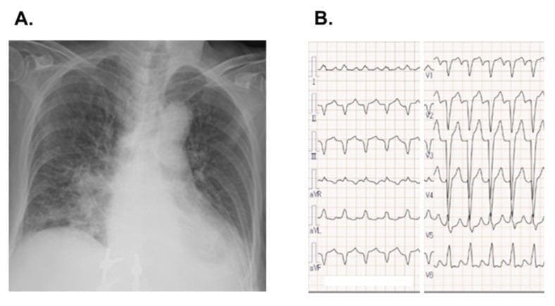 This composite diagnostic image features a posterobanterio (PA) chest X-ray and a 12-lead electrocardiogram (ECG) demonstrating cardiovascular complications. Image (A) is a chest radiograph showing significant cardiomegaly with a prominent cardiac silhouette and a cardiothoracic ratio greater than 0.5. There is evidence of bilateral pulmonary congestion, characterized by increased interstitial markings and hazy opacities, particularly in the perihilar regions and lower lung fields, consistent with acute heart failure. Image (B) displays a 12-lead ECG demonstrating a wide QRS complex (exceeding 120 ms) with a morphology characteristic of a complete left bundle branch block (LBBB), including deep S-waves in lead V1 and broad, notched R-waves in the lateral leads. Notably, there is poor R-wave progression across the precordial leads (V1–V4), which can be seen in anteroseptal myocardial injury or dilated cardiomyopathy. The combination of images illustrates clinical findings of drug-induced (osimertinib) cardiotoxicity, highlighting the relationship between structural cardiac changes (dilation/failure) and corresponding electrical conduction abnormalities.